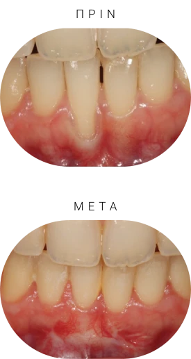 Treatment of Gum Recession before and after - Smile Design
